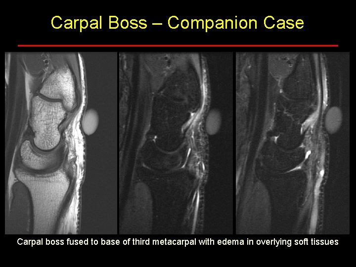 Carpal Boss – Companion Case Carpal boss fused to base of third metacarpal with Carpal Boss – Companion Case Carpal boss fused to base of third metacarpal with