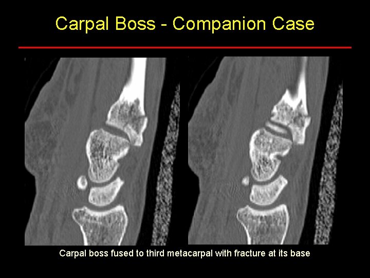 Carpal Boss - Companion Case Carpal boss fused to third metacarpal with fracture at Carpal Boss - Companion Case Carpal boss fused to third metacarpal with fracture at