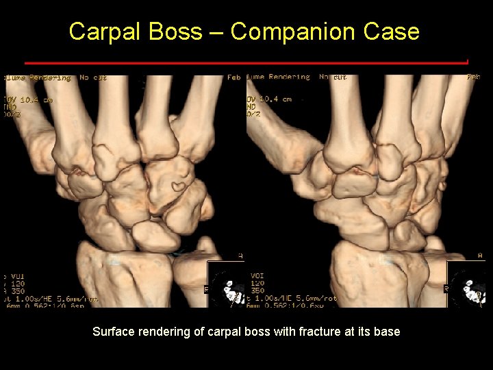 Carpal Boss – Companion Case Surface rendering of carpal boss with fracture at its Carpal Boss – Companion Case Surface rendering of carpal boss with fracture at its