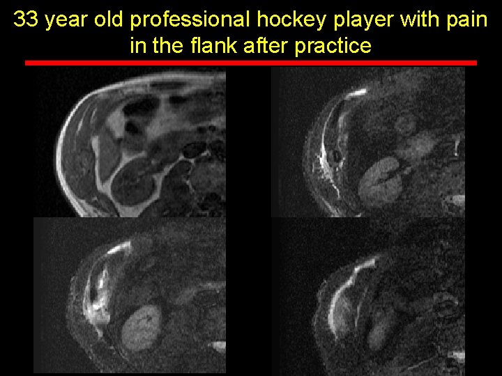 33 year old professional hockey player with pain in the flank after practice 33 year old professional hockey player with pain in the flank after practice