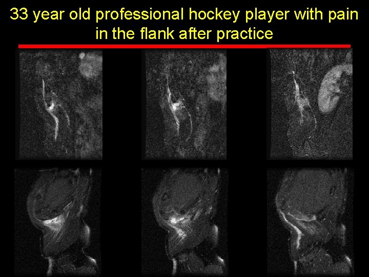 33 year old professional hockey player with pain in the flank after practice 33 year old professional hockey player with pain in the flank after practice
