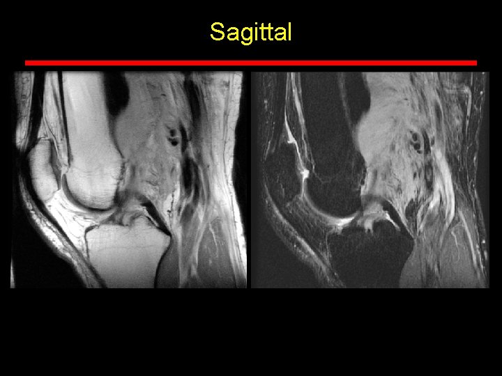 Sagittal Sagittal