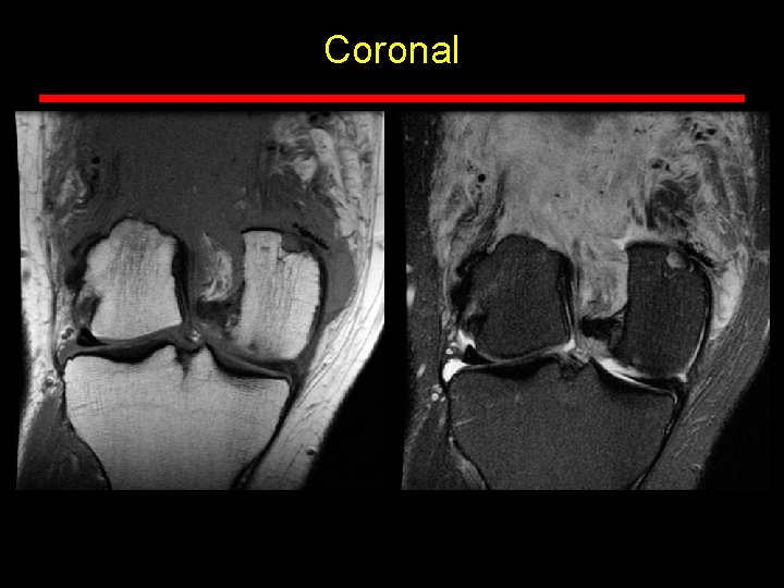 Coronal Coronal