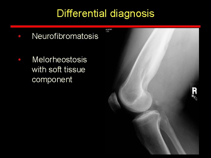 Differential diagnosis • Neurofibromatosis • Melorheostosis with soft tissue component Differential diagnosis • Neurofibromatosis • Melorheostosis with soft tissue component
