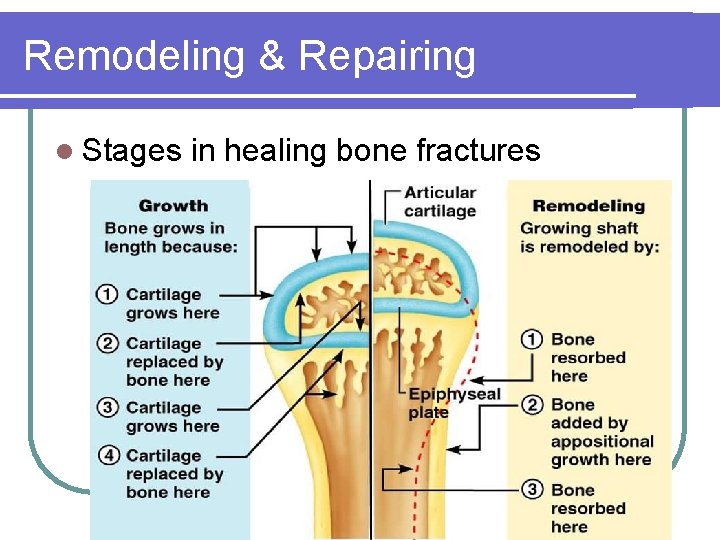 Remodeling & Repairing l Stages in healing bone fractures 