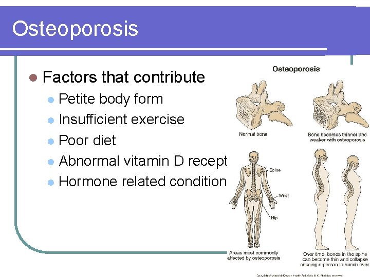 Osteoporosis l Factors that contribute Petite body form l Insufficient exercise l Poor diet