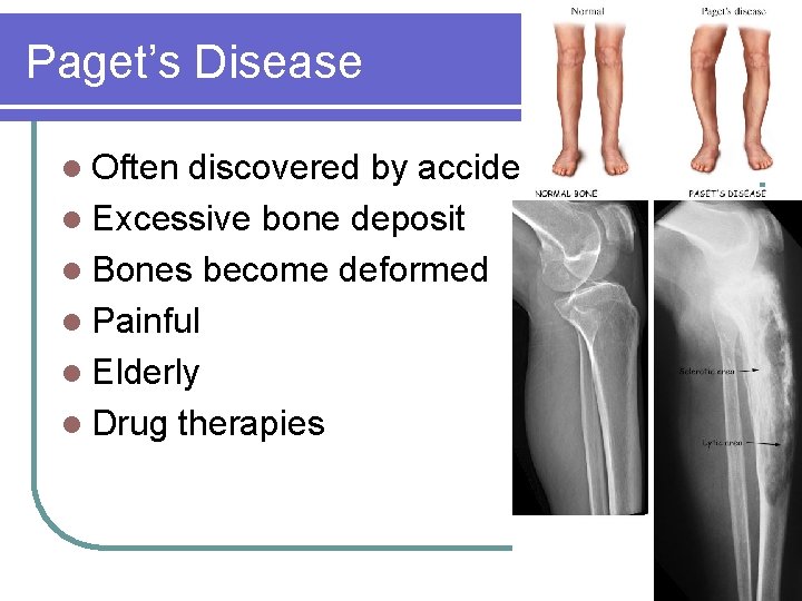 Paget’s Disease l Often discovered by accident l Excessive bone deposit l Bones become