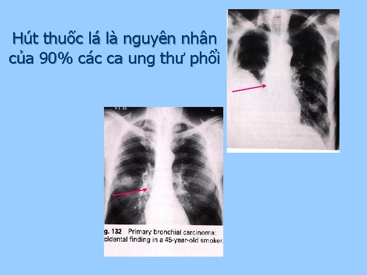 Hút thuốc lá là nguyên nhân của 90% các ca ung thư phổi 