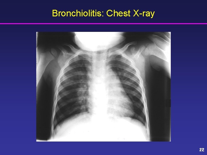 Bronchiolitis: Chest X-ray 22 