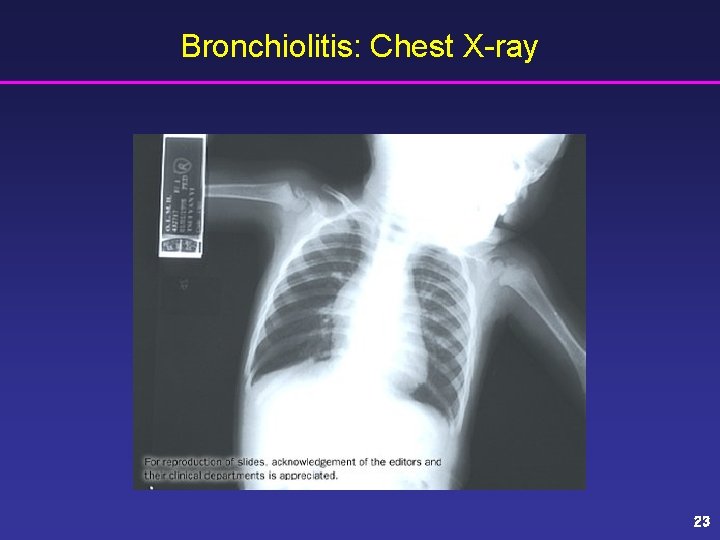 Bronchiolitis: Chest X-ray 23 