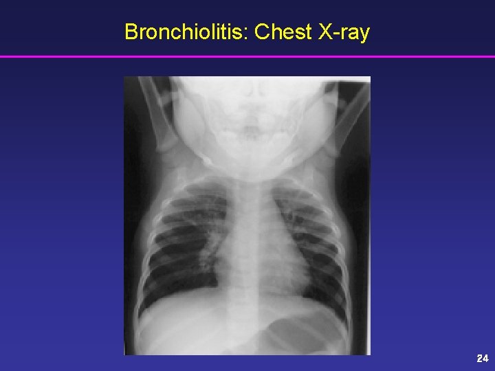 Bronchiolitis: Chest X-ray 24 