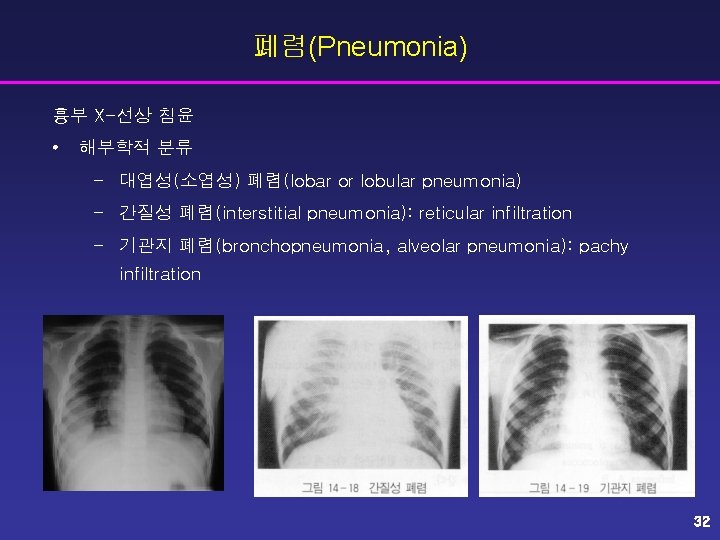 폐렴(Pneumonia) 흉부 X-선상 침윤 • 해부학적 분류 – 대엽성(소엽성) 폐렴(lobar or lobular pneumonia) –