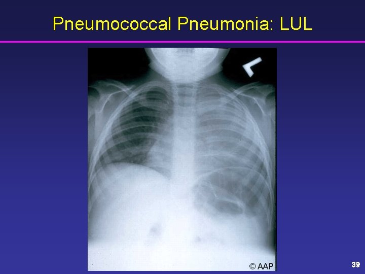 Pneumococcal Pneumonia: LUL 39 