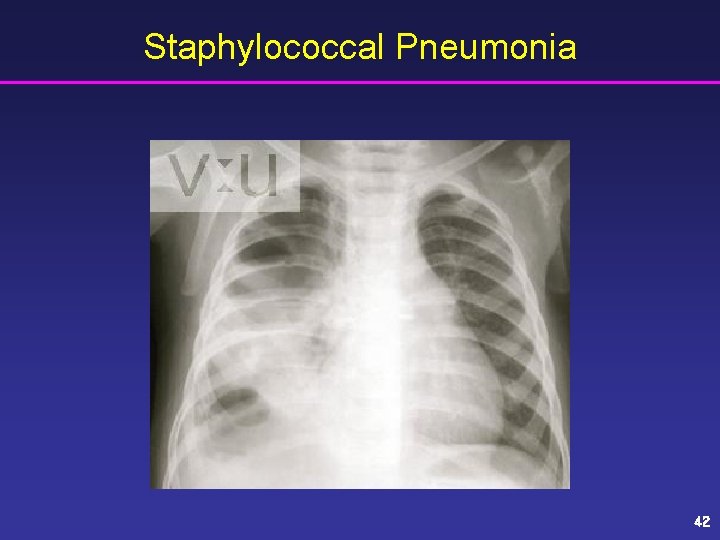 Staphylococcal Pneumonia 42 