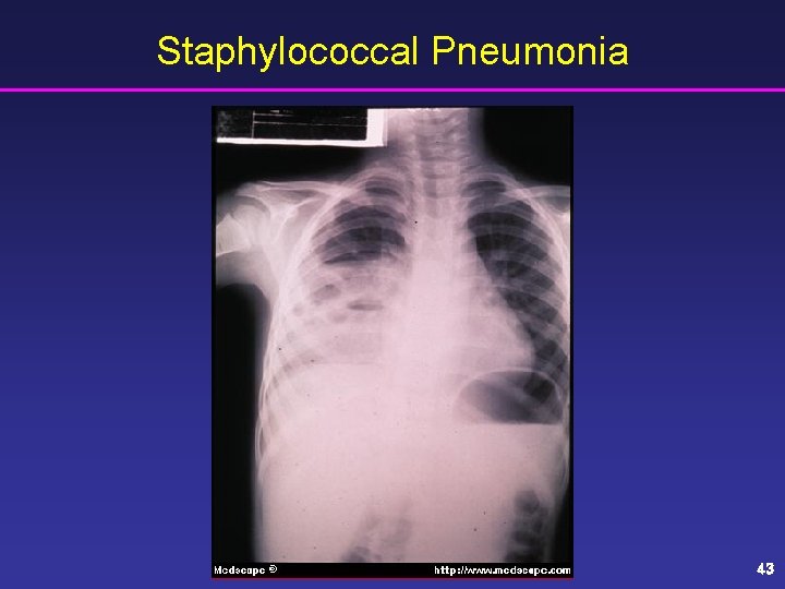 Staphylococcal Pneumonia 43 