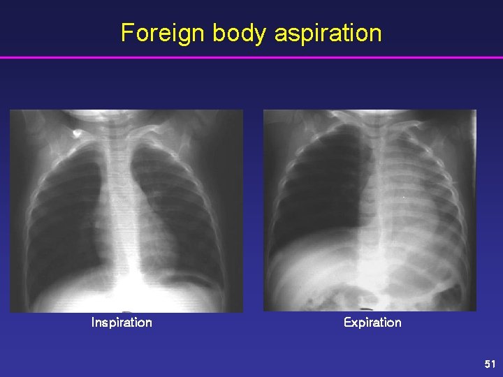 Foreign body aspiration Inspiration Expiration 51 