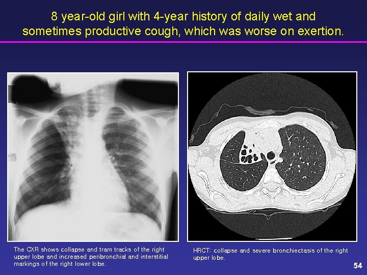 8 year-old girl with 4 -year history of daily wet and sometimes productive cough,