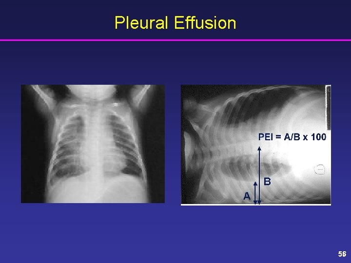 Pleural Effusion 56 