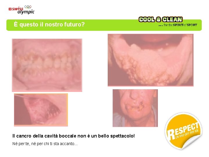 È questo il nostro futuro? Il cancro della cavità boccale non è un bello È questo il nostro futuro? Il cancro della cavità boccale non è un bello