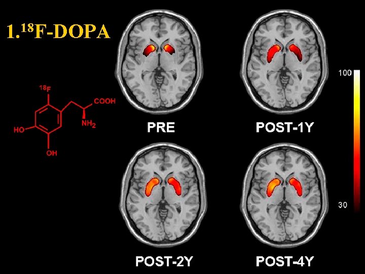 PETCT PETCT in the Neurodegenerative disease PET PET