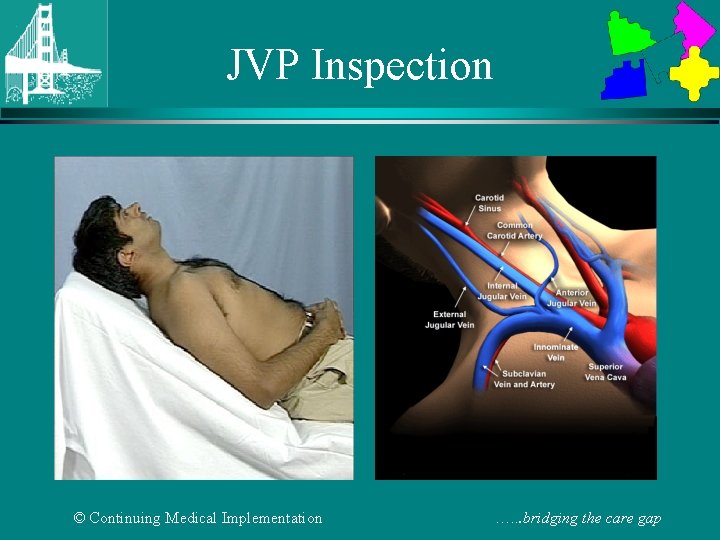 JVP Inspection © Continuing Medical Implementation …. . . bridging the care gap 