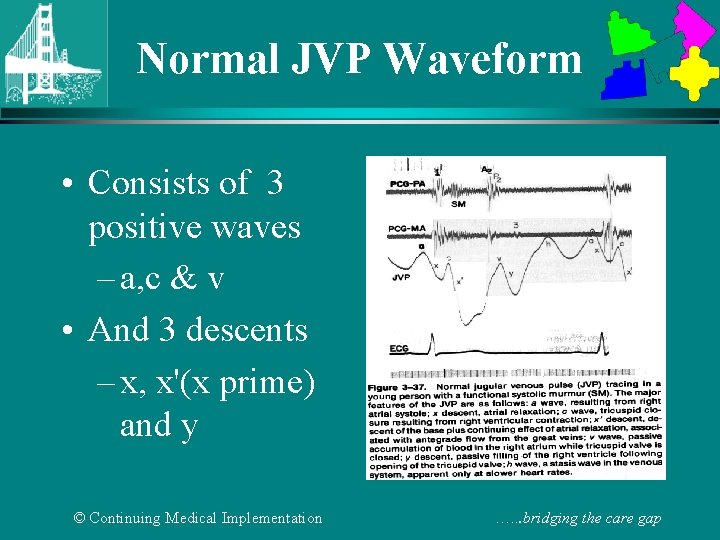 Normal JVP Waveform • Consists of 3 positive waves – a, c & v