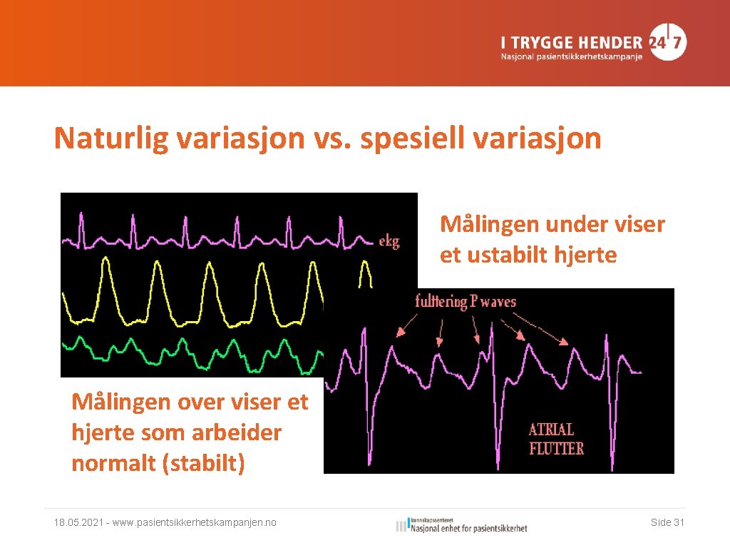 Naturlig variasjon vs. spesiell variasjon Målingen under viser et ustabilt hjerte Målingen over viser