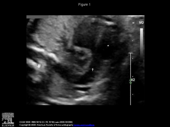 Figure 1 CASE 2020 4356 -361 DOI: (10. 1016/j. case. 2020. 05. 009) Copyright