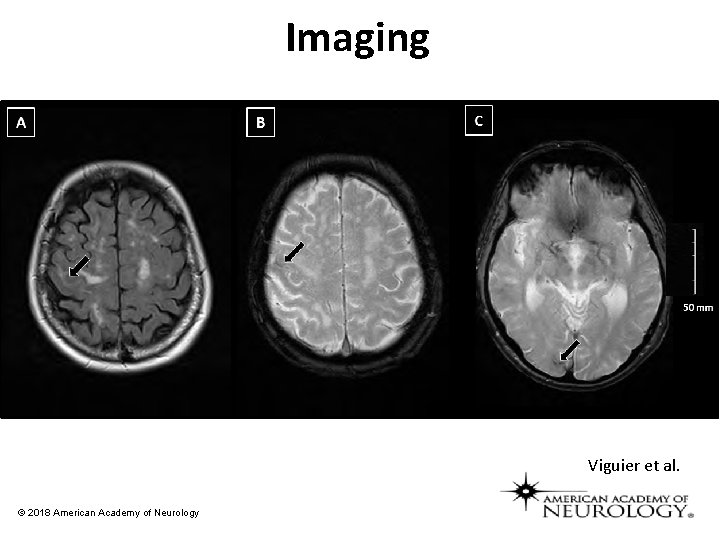 Imaging Viguier et al. © 2018 American Academy of Neurology 