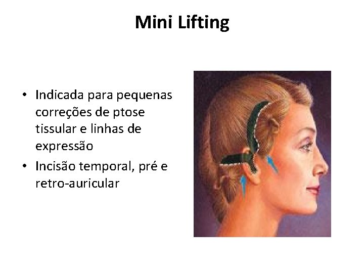 Mini Lifting • Indicada para pequenas correções de ptose tissular e linhas de expressão