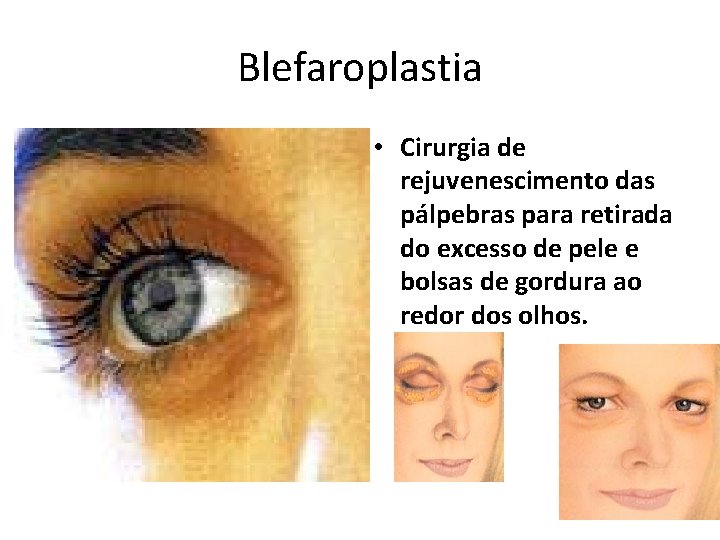 Blefaroplastia • Cirurgia de rejuvenescimento das pálpebras para retirada do excesso de pele e