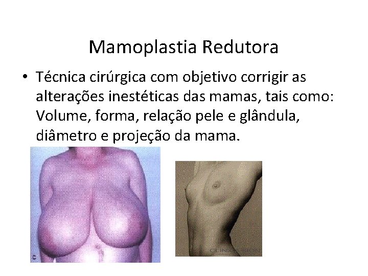 Mamoplastia Redutora • Técnica cirúrgica com objetivo corrigir as alterações inestéticas das mamas, tais