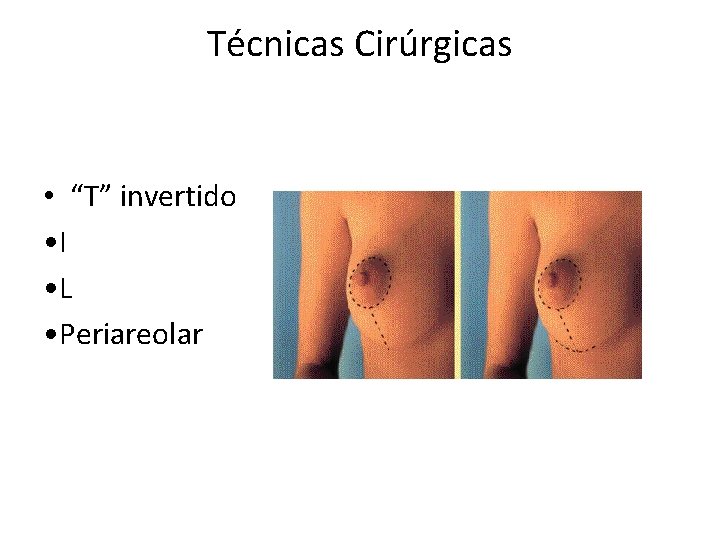 Técnicas Cirúrgicas • “T” invertido • I • L • Periareolar 