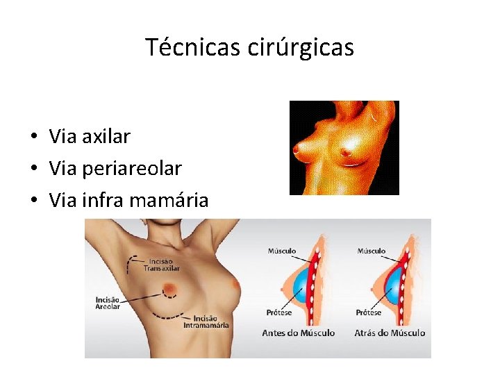 Técnicas cirúrgicas • Via axilar • Via periareolar • Via infra mamária 