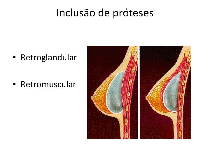 Inclusão de próteses • Retroglandular • Retromuscular 