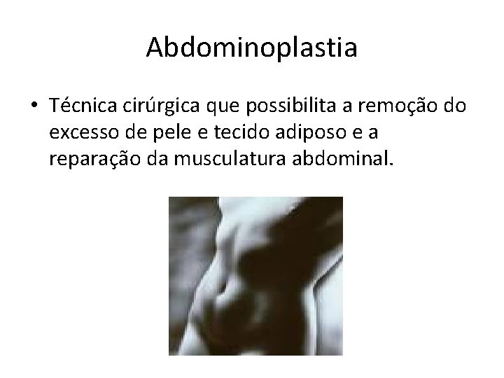 Abdominoplastia • Técnica cirúrgica que possibilita a remoção do excesso de pele e tecido