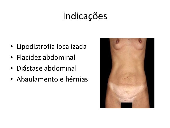 Indicações • • Lipodistrofia localizada Flacidez abdominal Diástase abdominal Abaulamento e hérnias 