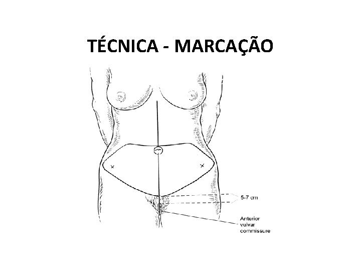 TÉCNICA - MARCAÇÃO 