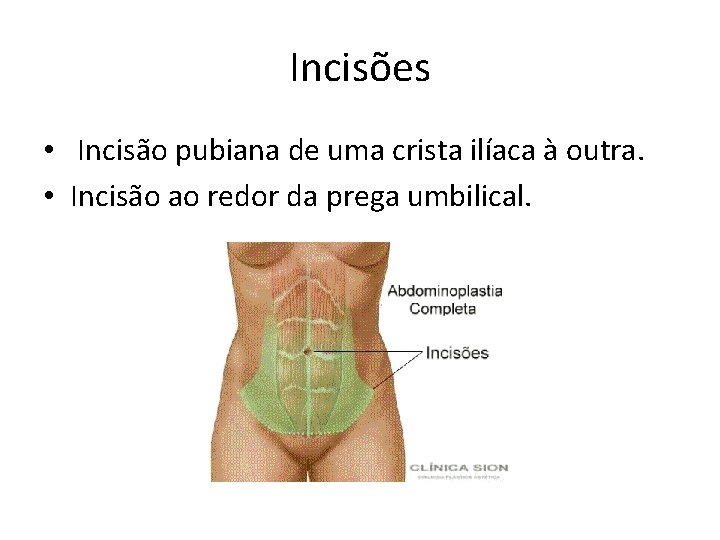 Incisões • Incisão pubiana de uma crista ilíaca à outra. • Incisão ao redor