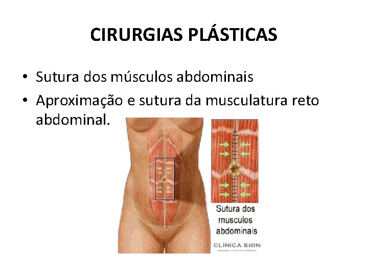 CIRURGIAS PLÁSTICAS • Sutura dos músculos abdominais • Aproximação e sutura da musculatura reto