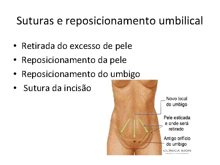 Suturas e reposicionamento umbilical • • Retirada do excesso de pele Reposicionamento da pele