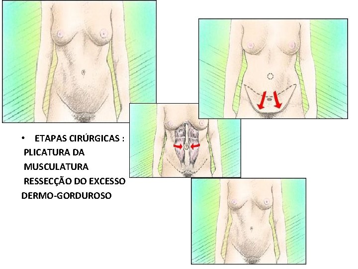  • ETAPAS CIRÚRGICAS : PLICATURA DA MUSCULATURA RESSECÇÃO DO EXCESSO DERMO-GORDUROSO 