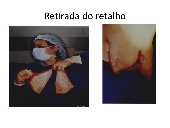 Retirada do retalho 