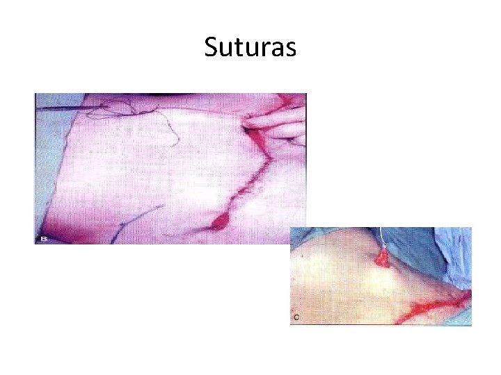 Suturas 