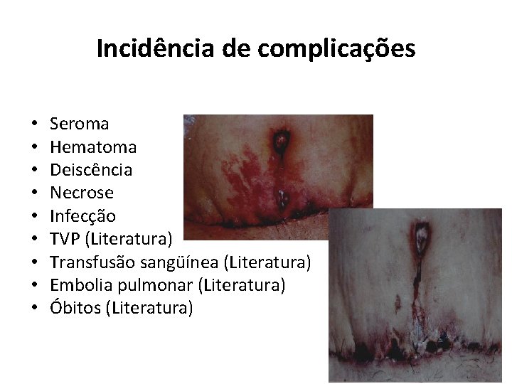 Incidência de complicações • • • Seroma Hematoma Deiscência Necrose Infecção TVP (Literatura) Transfusão