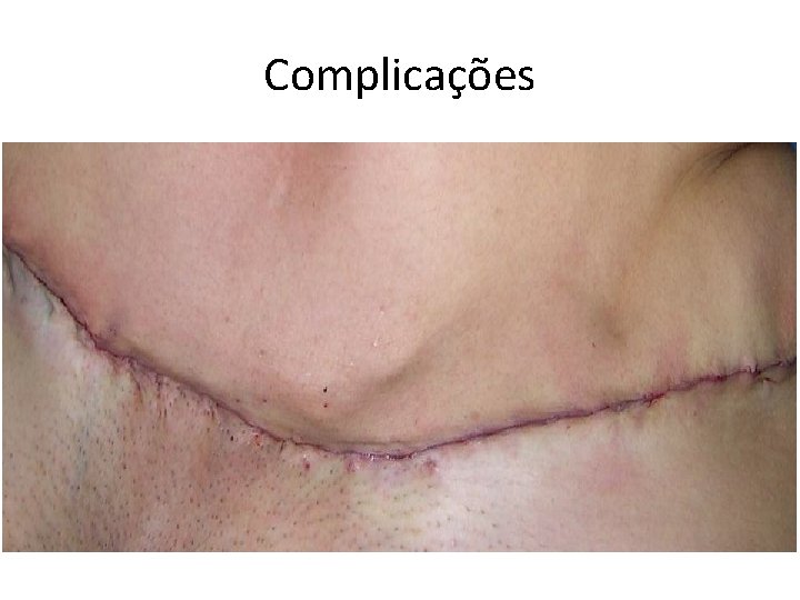 Complicações 