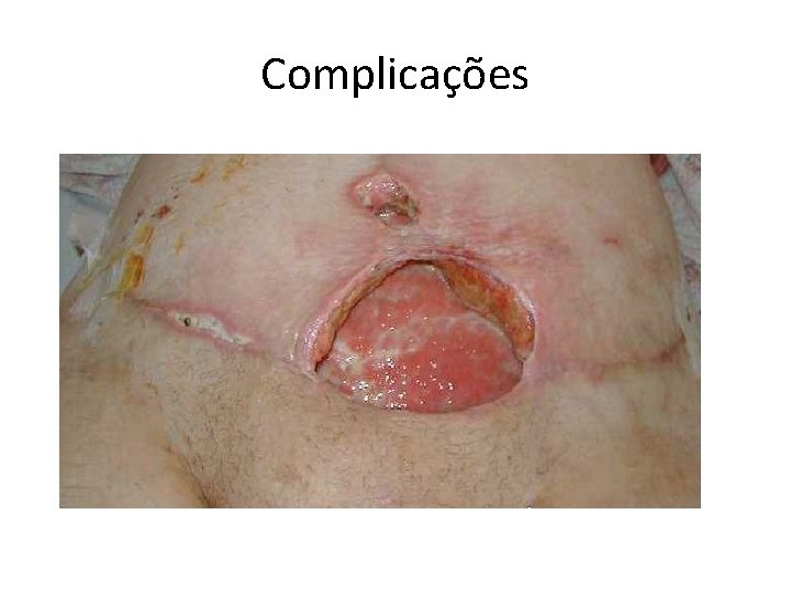 Complicações 