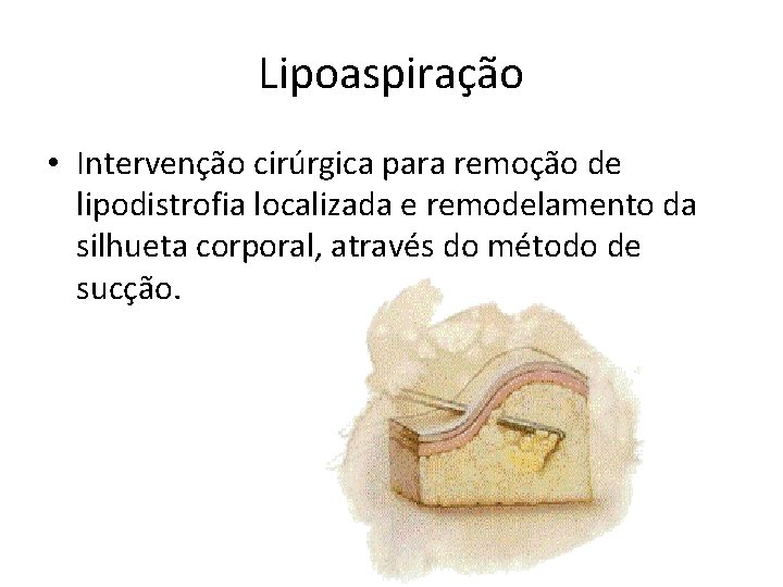 Lipoaspiração • Intervenção cirúrgica para remoção de lipodistrofia localizada e remodelamento da silhueta corporal,