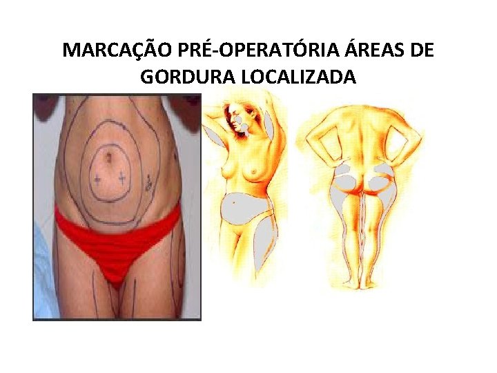 MARCAÇÃO PRÉ-OPERATÓRIA ÁREAS DE GORDURA LOCALIZADA 