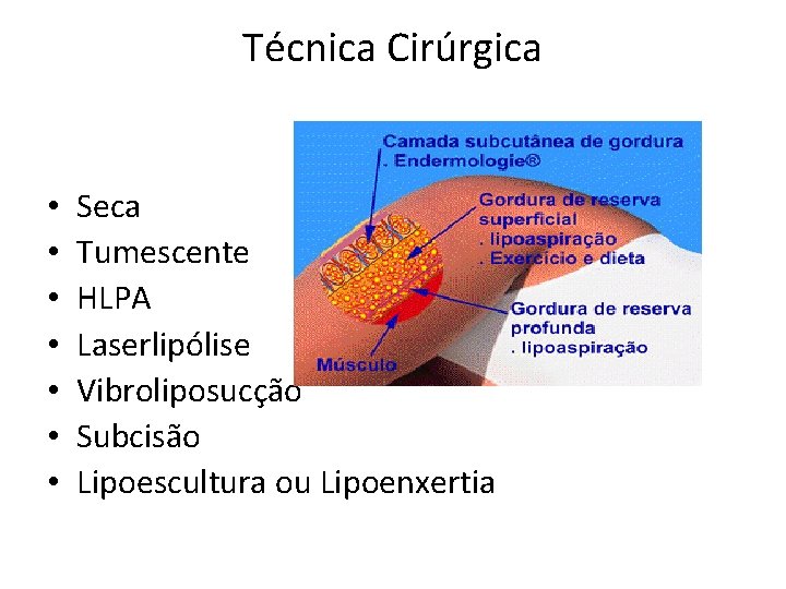 Técnica Cirúrgica • • Seca Tumescente HLPA Laserlipólise Vibroliposucção Subcisão Lipoescultura ou Lipoenxertia 